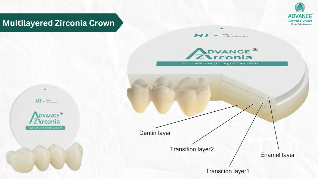 Multilayere- Zirconia-Crown